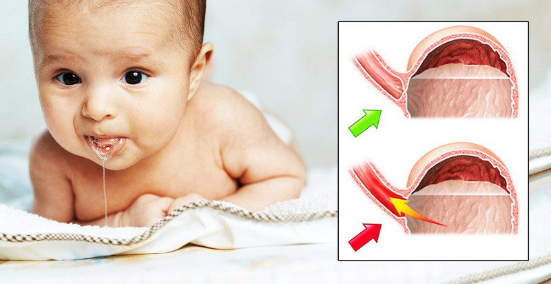 Em bé nằm trên gối chống trào ngược để hạn chế tình trạng ọc sữa