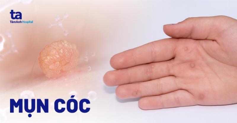 Hình ảnh cận cảnh các vết thâm mụn trên da, giải thích quá trình hình thành thâm mụn và lý do chúng khó biến mất sau một đêm