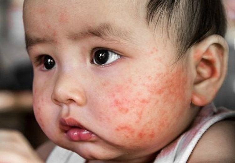 Em bé bị chàm, làn da khô và bong tróc, cho thấy một nguyên nhân gây bong tróc da ở trẻ sơ sinh